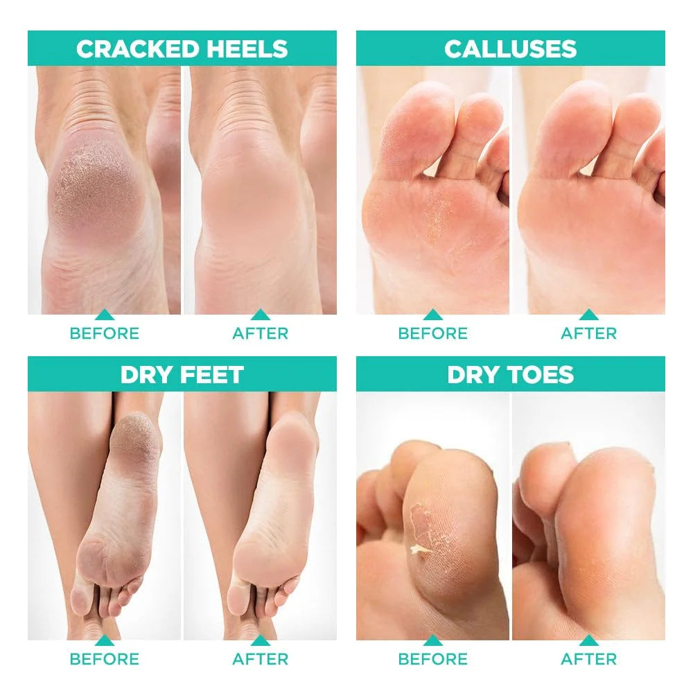 Foot Peel Mask for Dry Cracked Feet – 2 Pack Dead Skin Remover Foot Mask for Cracked Feet and Callus - Exfoliating Feet Peeling Mask for Soft Baby Feet, Original Scent
